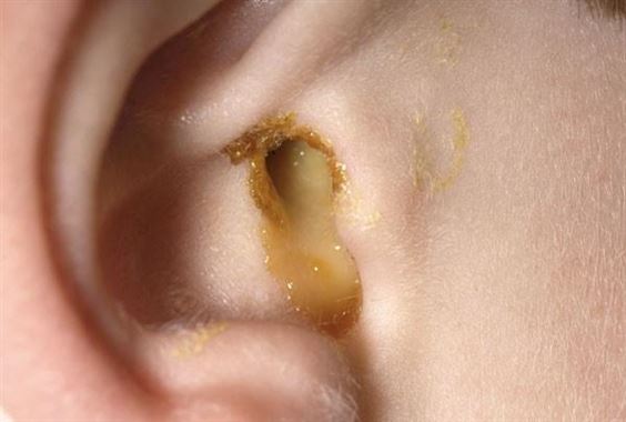Nguyên nhân gây bệnh viêm tai giữa là gì?